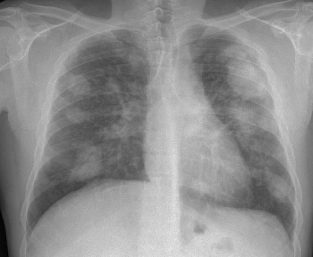 maquinas de captacion de polvo para prevención de la silicosis